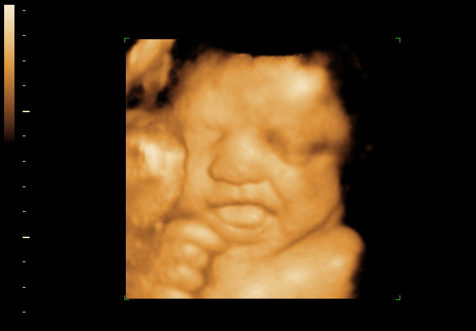 3D ultrasound image at 28 weeks